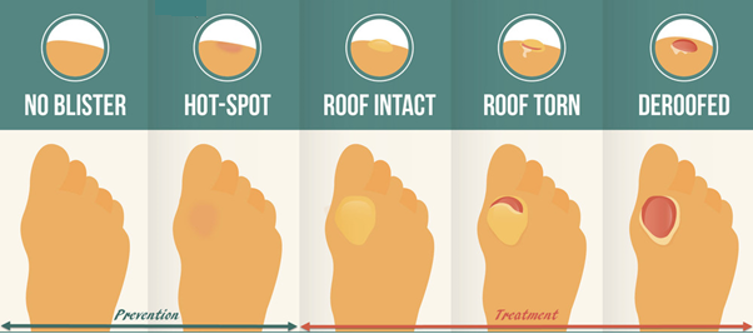 4 Stages of a blister