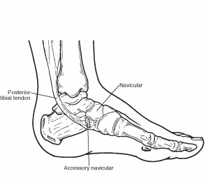 Diagram of a foot skeleton showing Accessory Bones (Extra bones) of the Foot