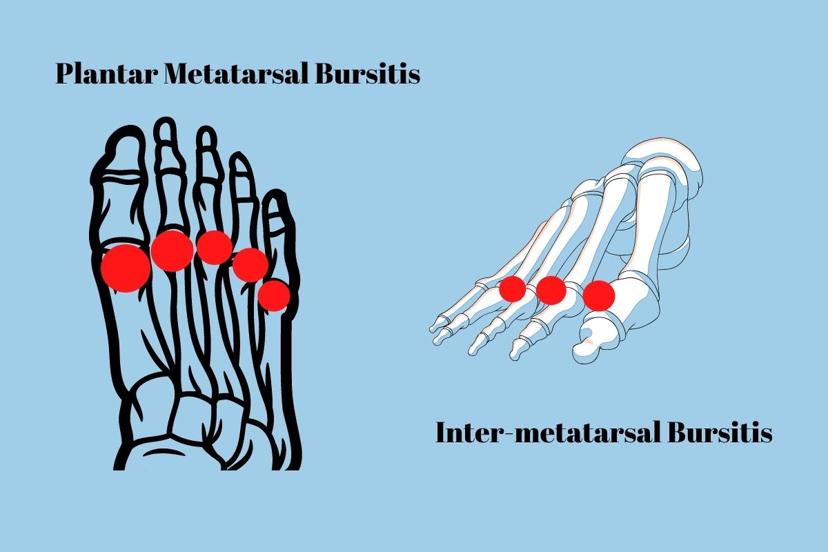 Image of Plantar Metatarsal Bursitis and inter-metatarsal bursitis showing why does the pad of my foot hurt when I walk?