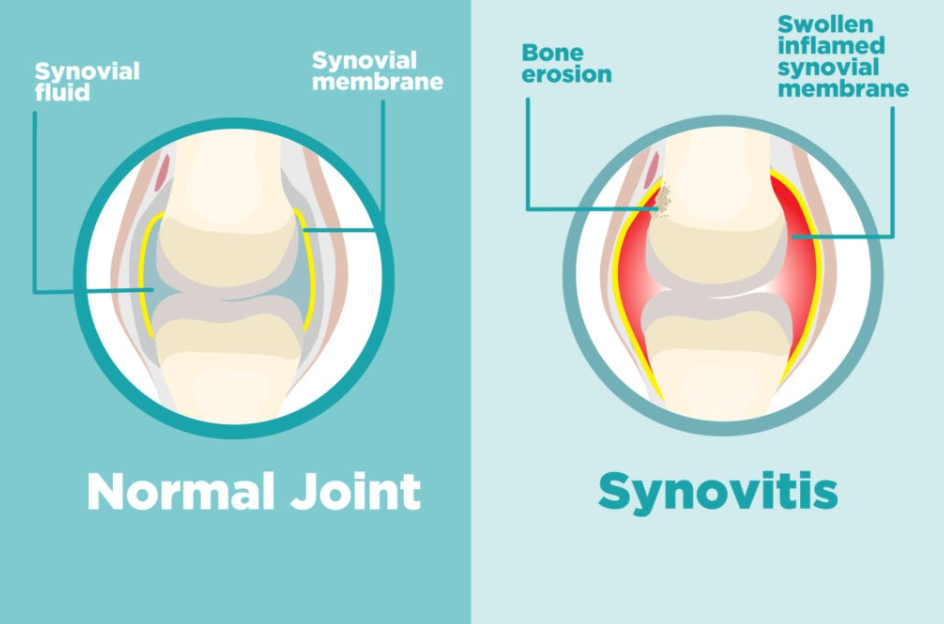 Normal joint compared to synovitis showing why does the pad of my foot hurt when I walk?