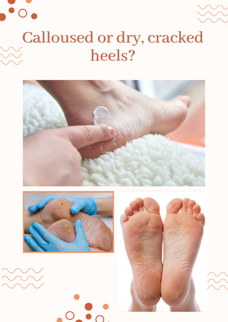 Image of cracked heels and treatments